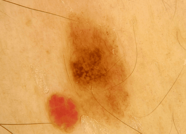 Wideodermatoskopia - zmapowane znamię nr 35.