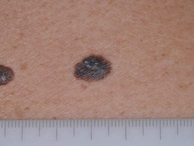 Czerniak skóry - melanoma zdjęcie dermatologiczne nowotwór barwnikowy