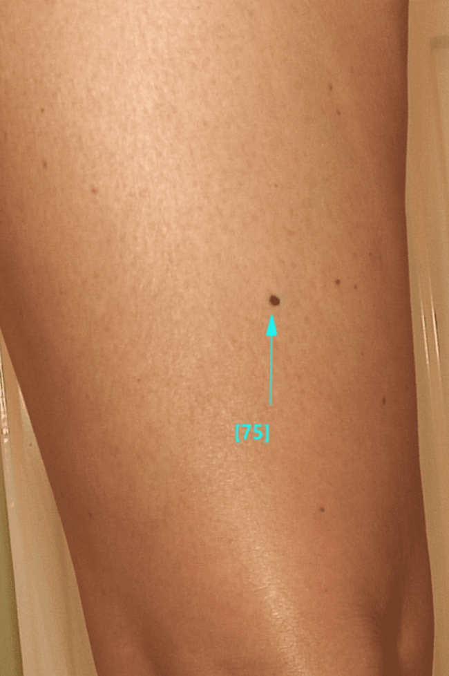 brzydkie kaczątko - znamię dysplastyczne