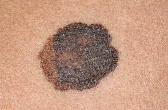 Czerniak złośliwy skóry - melanoma zdjęcie medyczne przykład kliniczny