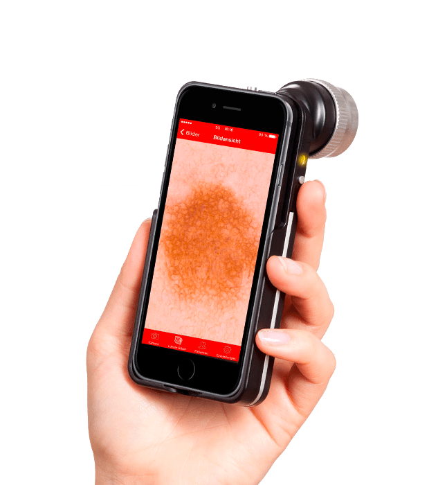 Dermatoskop ręczny Handysope, powiększenie do 20 x, nakładka współpracuje z iPhonem oraz Ipodem Touch