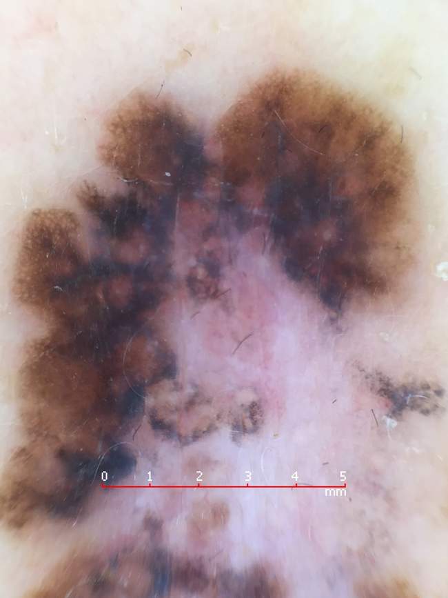 Klasyczny dermatoskopowy obraz czerniaka