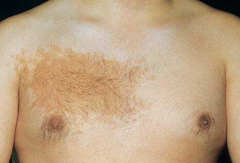 Znamię Beckera - Becker nevus melanoza Beckera przebarwienie z włosami zdjęcie