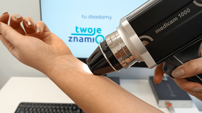 Badanie wideodermatoskopowe w ośrodku Twoje Znamiona - profesjonalna diagnostyka znamion pacjentka podczas badania dermatoskopowego