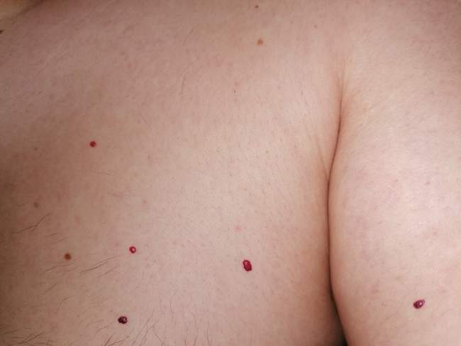 Naczyniaki rubinowe (cherry angioma) - jaskrawo czerwone kropki na skórze