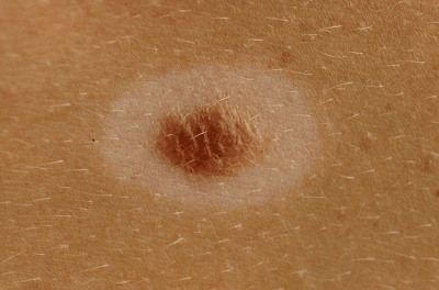 Znamię Suttona - Sutton nevus halo nevus znamię z odbarwieniem białą obwódką