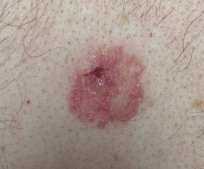 Rak podstawnokomórkowy