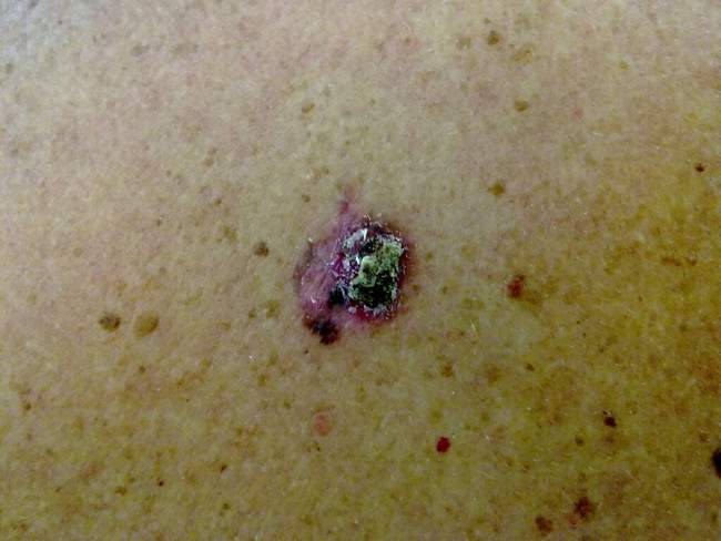 Czerniak skóry - melanoma zdjęcie dermatologiczne przykład kliniczny