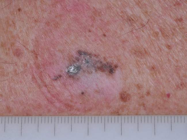 Czerniak skóry - melanoma zdjęcie kliniczne podejrzana zmiana barwnikowa