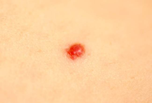 Naczyniak - hemangioma diagnostyka różnicowa czerniak zdjęcie kliniczne