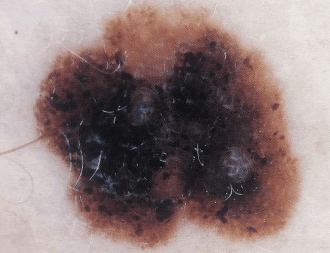 Czerniak złośliwy - melanoma różnorodność barw ABCDE zdjęcie kliniczne