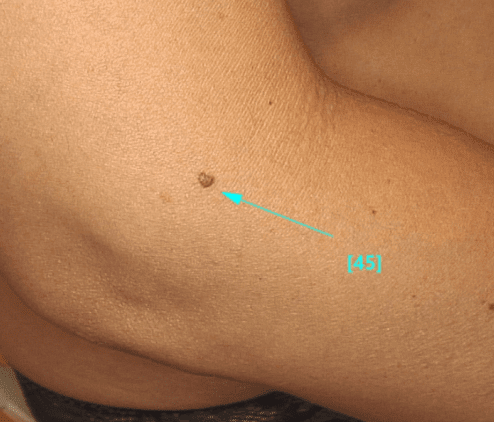 Zwykłe znamię barwnikowe - łagodny pieprzyk zdjęcie medyczne