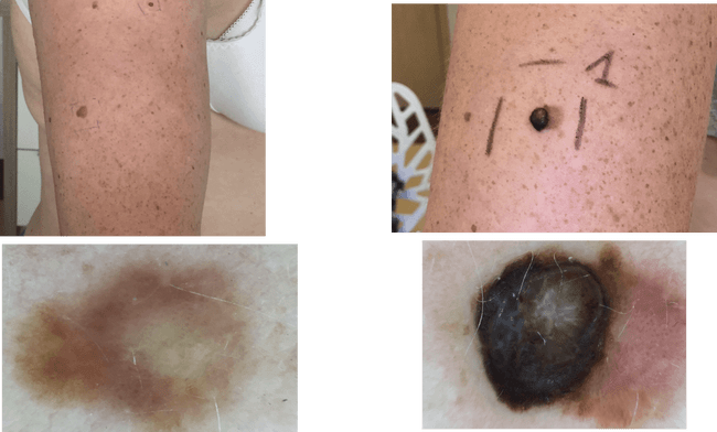 Czerniak skóry - melanoma zdjęcie dermatologiczne przykład kliniczny