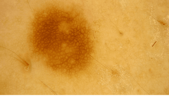 Zwykłe znamię barwnikowe - typowy pieprzyk zdjęcie medyczne