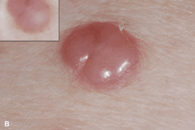 Czerniak guzkowaty - nodular melanoma zdjęcie medyczne typ guzkowaty