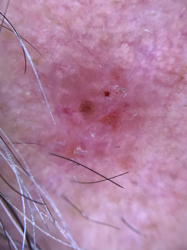 Obraz dermatoskopowy BCC