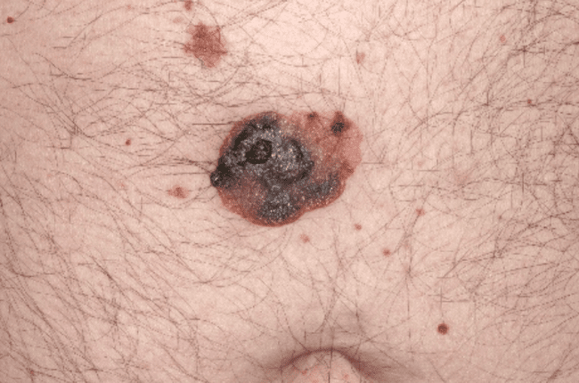 Czerniak złośliwy - melanoma zaawansowane stadium wrzodzenie zdjęcie medyczne