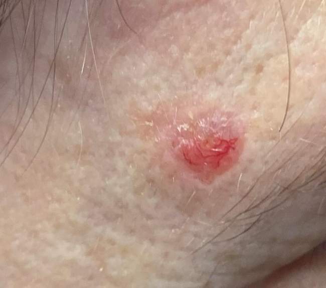 Rak podstawnokomórkowy typ guzkowaty - klasyczny perłowy guzek z teleangiektazjami i centralnym owrzodzeniem