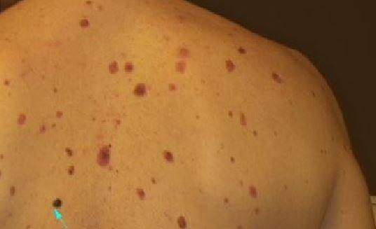 Czerniak u pacjenta z zespołem znamion dysplastycznych.