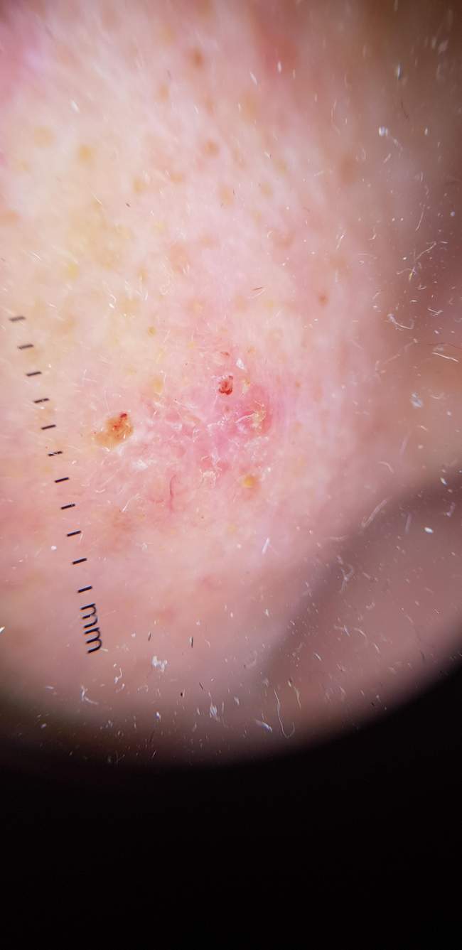 Rak podstawnokomórkowy - leczenie chirurgiczne - wycięcie z marginesem