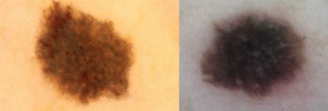 po lewej stronie znamię dysplastyczne, po prawej stronie czerniak