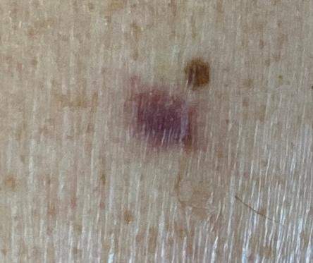 Rak podstawnokomórkowy podobny do włókniaka twardego