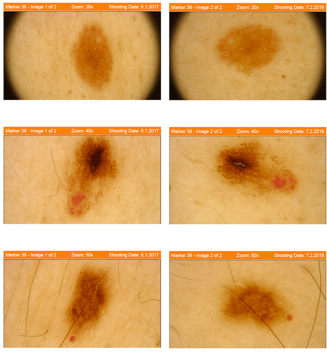 Raport badania wideodermatoskopowego u jednej z naszych pacjentek.
