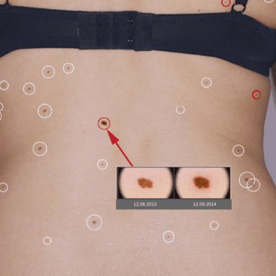 System dokonał automatycznej detekcji nowych zmian na ciele pacjentki.
