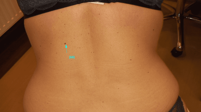 Zwykłe znamię barwnikowe - pieprzyk łagodny zdjęcie kliniczne