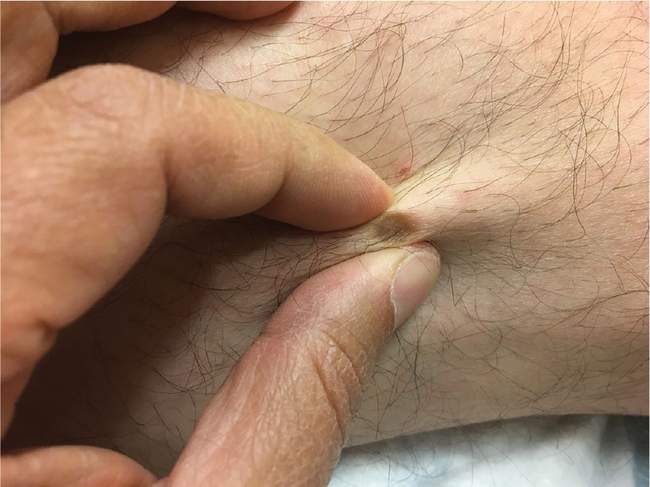 Włókniak twardy (dermatofibroma) - twardy brązowy guzek z charakterystycznym objawem dymplowania