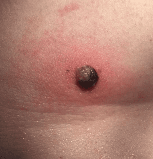 podrażniona brodawka łojotokowa