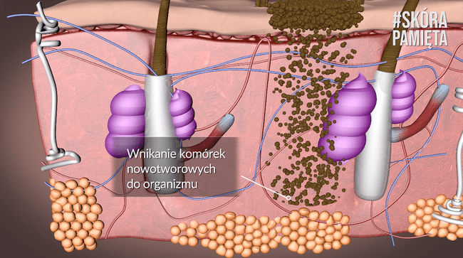 Komórki nowotworowe wnikają w głąb organizmu, przedostając się do naczyń krwionośnych i limfatycznych