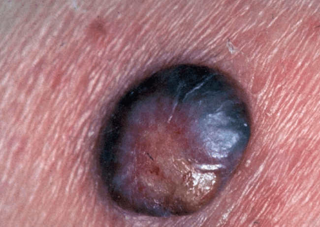 Czerniak złośliwy - melanoma typowy czerniak łuszczenie rogowacenie zdjęcie