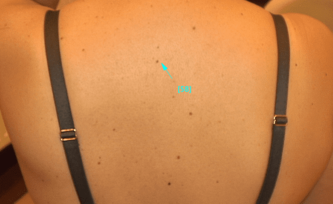 Zwykłe znamię barwnikowe - łagodny pieprzyk zdjęcie dermatologiczne