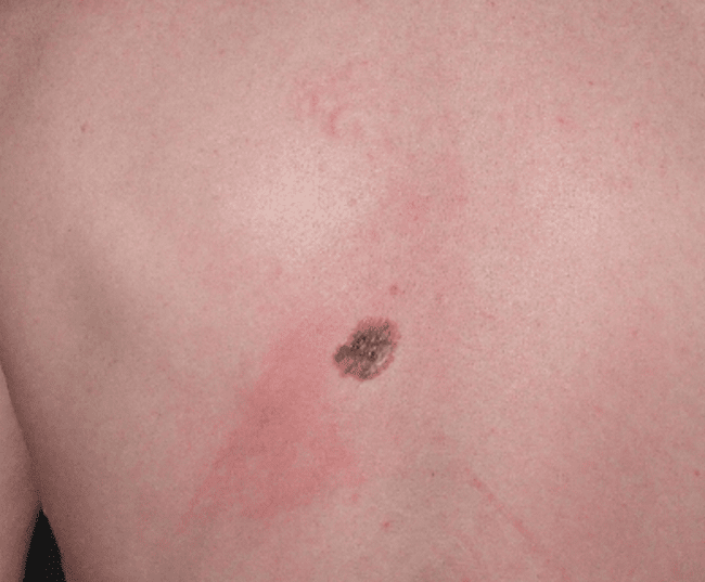 brzydkie kaczątko - czerniak