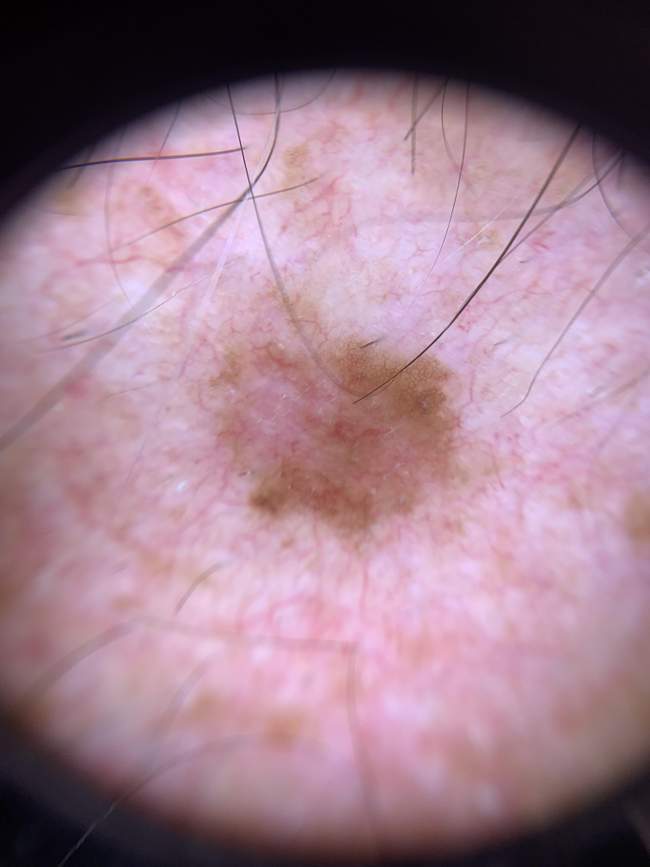 Rak podstawnokomórkowy nosa - owrzodzenie z krwawieniem - zmiana z charakterystycznym centralnym owrzodzeniem