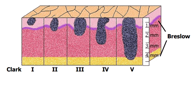 Grubość nacieku według Breslowa