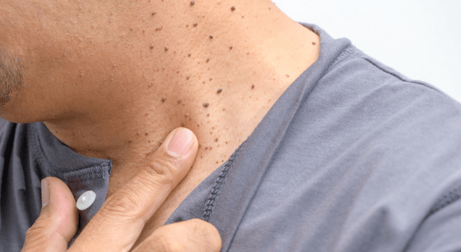 Włókniaki miękkie na szyi - małe woreczkowate wyrostki skórne zwisające na szypułkach