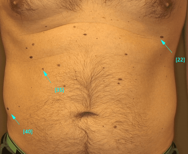 Wideodermatoskopia - mapowanie znamion.