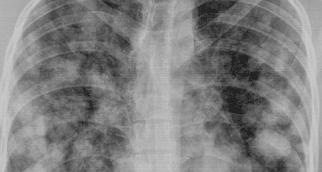 Przerzuty w płucach - objaw zaawansowanego czerniaka.