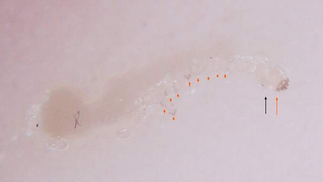 Obraz świerzbu w badaniu dermatoskopowym