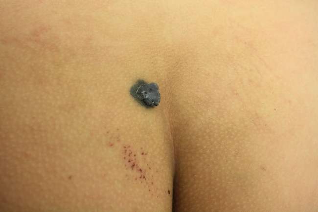 Znamię błękitne - blue nevus diagnostyka różnicowa czerniak zdjęcie dermatologiczne